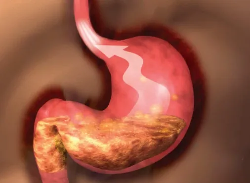 Acid Reflux - GERD (Gastroesophageal Reflux Disease) consultation at Niraaya Hospital